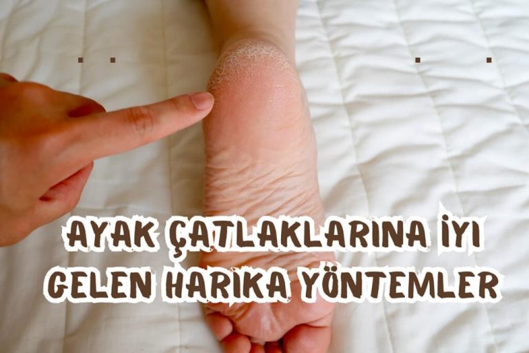 Ayak Çatlakları