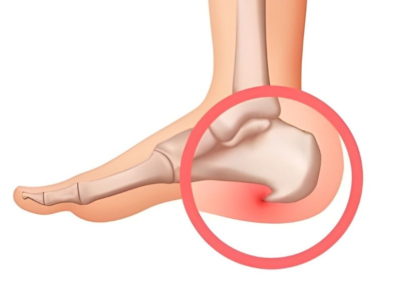 Topuk Dikeni Olanlar Nasıl Ayakkabı Giymeli?